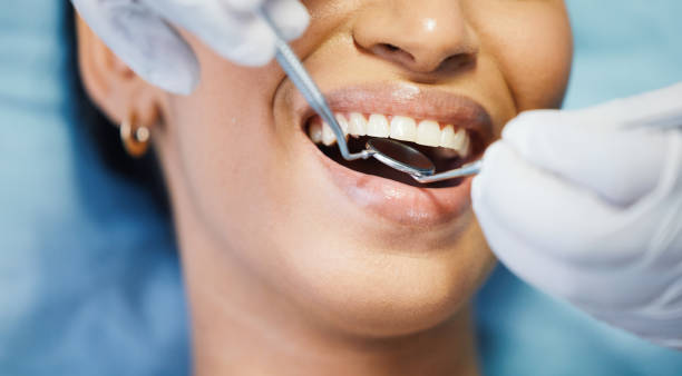Best Knocked-Out Tooth (Avulsed Tooth) Treatment in La Cresta, CA